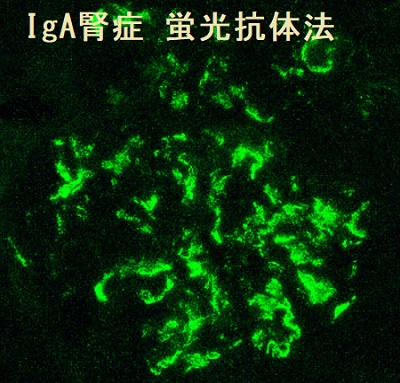 IgA腎症 蛍光抗体法 IgA腎症 蛍光抗体法