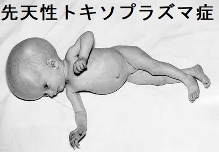 先天性トキソプラズマ症 先天性トキソプラズマ症