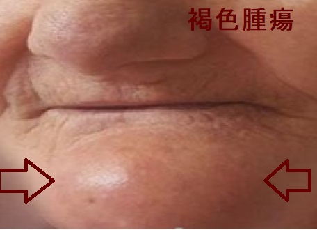 下顎褐色腫瘍 下顎褐色腫瘍