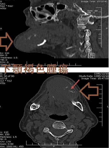 下顎褐色腫瘍 単純CT画像 下顎褐色腫瘍 単純CT画像