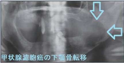 甲状腺濾胞癌の下顎骨転移 甲状腺濾胞癌の下顎骨転移