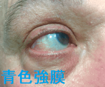 青色強膜 青色強膜