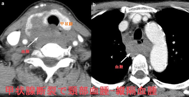 甲状腺断裂で頸部血腫が気管圧排 甲状腺断裂で頸部血腫が気管圧排