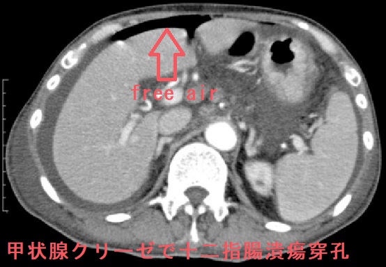 甲状腺クリーゼで十二指腸潰瘍穿孔 甲状腺クリーゼで十二指腸潰瘍穿孔