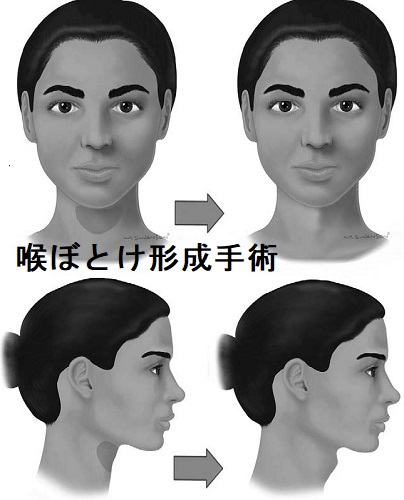 喉ぼとけ形成手術 トランスジェンダーと甲状腺 喉ぼとけ形成手術 トランスジェンダーと甲状腺