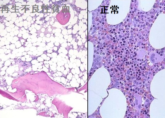 再生不良性貧血の骨髄 再生不良性貧血の骨髄
