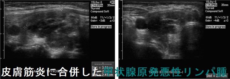 皮膚筋炎に合併した甲状腺原発悪性リンパ腫 皮膚筋炎に合併した甲状腺原発悪性リンパ腫