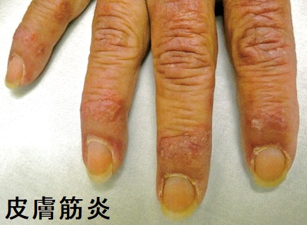皮膚筋炎(ゴットロン徴候、ゴットロン丘疹) 皮膚筋炎(ゴットロン徴候、ゴットロン丘疹)