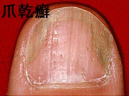 爪乾癬 爪乾癬