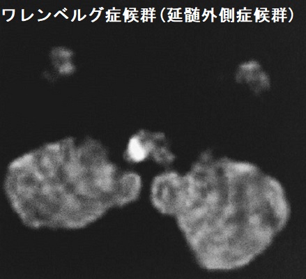 延髄外側梗塞(Wallenberg症候群)MRI拡散強調像 延髄外側梗塞(Wallenberg症候群)MRI拡散強調像