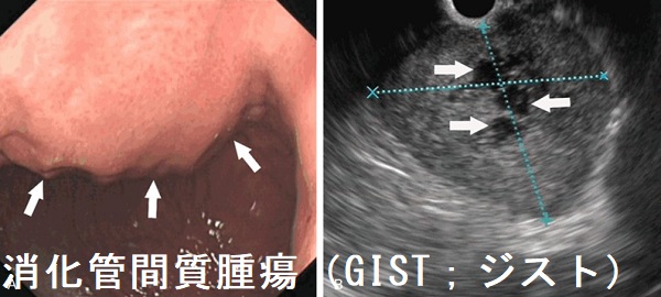 消化管間質腫瘍(GIST;ジスト) 消化管間質腫瘍(GIST;ジスト)