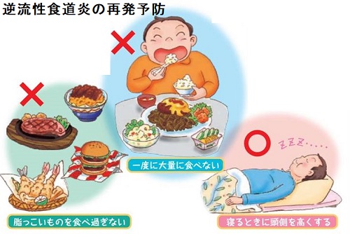 逆流性食道炎の再発予防 逆流性食道炎の再発予防