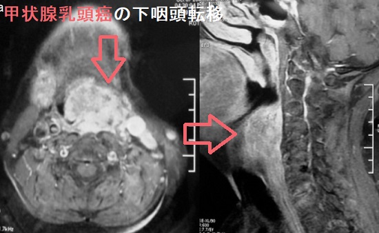 甲状腺乳頭癌の下咽頭転移 甲状腺乳頭癌の下咽頭転移