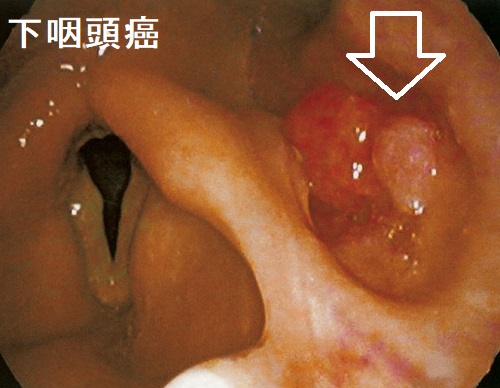 下咽頭癌 下咽頭癌
