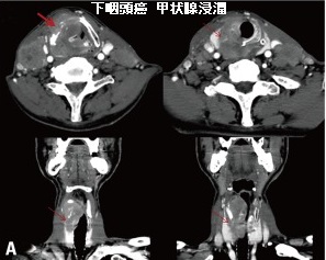 下咽頭癌 甲状腺浸潤 下咽頭癌 甲状腺浸潤