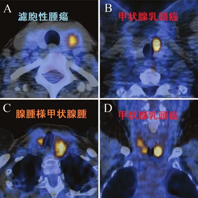 甲状腺結節のFDG-PET 甲状腺結節のFDG-PET