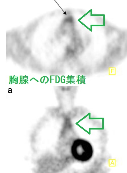 胸腺へのFDG集積 胸腺へのFDG集積