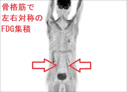 骨格筋で左右対称のFDG集積 骨格筋で左右対称のFDG集積