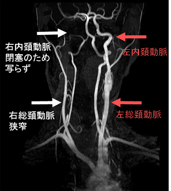 甲状腺機能亢進症/バセドウ病で、内頚動脈閉塞・狭窄、総頚動脈狭窄 甲状腺機能亢進症/バセドウ病で、内頚動脈閉塞・狭窄、総頚動脈狭窄
