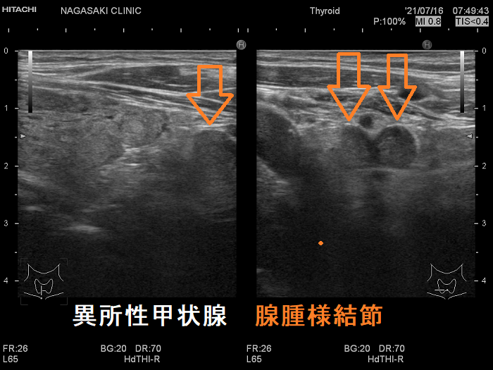 腺腫様甲状腺腫の異所性甲状腺 腺腫様甲状腺腫の異所性甲状腺