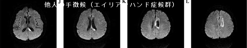 他人の手徴候(エイリアンハンド症候群)MRI拡散強調画像 他人の手徴候(エイリアンハンド症候群)MRI拡散強調画像