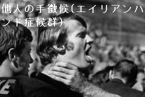 他人の手徴候(エイリアンハンド症候群) 他人の手徴候(エイリアンハンド症候群)
