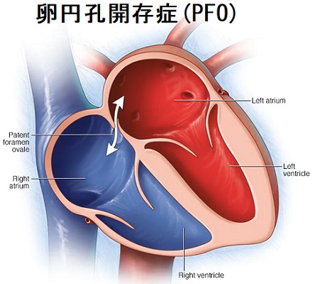 卵円孔開存症(PFO) 卵円孔開存症(PFO)