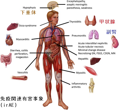 免疫チェックポイント阻害薬(ICI)による甲状腺・下垂体・副腎免疫関連有害事象 (irAE) 免疫チェックポイント阻害薬(ICI)による甲状腺・下垂体・副腎免疫関連有害事象 (irAE)