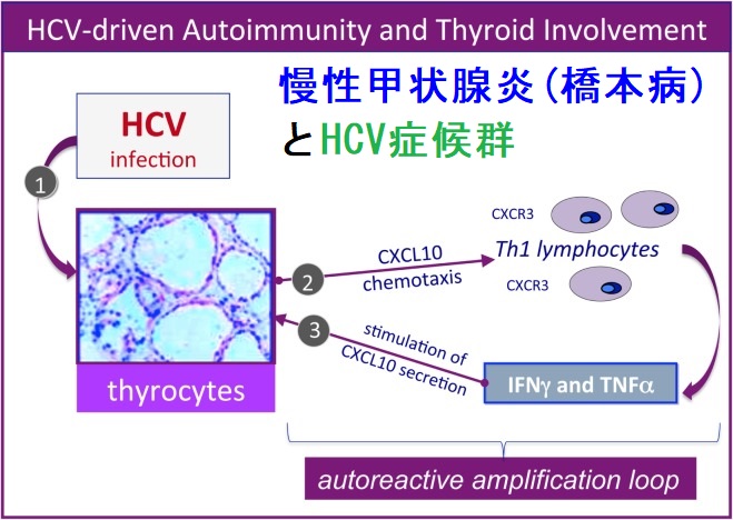 慢性甲状腺炎(橋本病)とHCV症候群 慢性甲状腺炎(橋本病)とHCV症候群