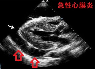 急性心膜炎 超音波(エコー)画像 急性心膜炎 超音波(エコー)画像