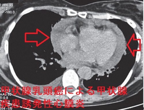 甲状腺乳頭癌による甲状腺疾患誘発性心膜炎 甲状腺乳頭癌による甲状腺疾患誘発性心膜炎