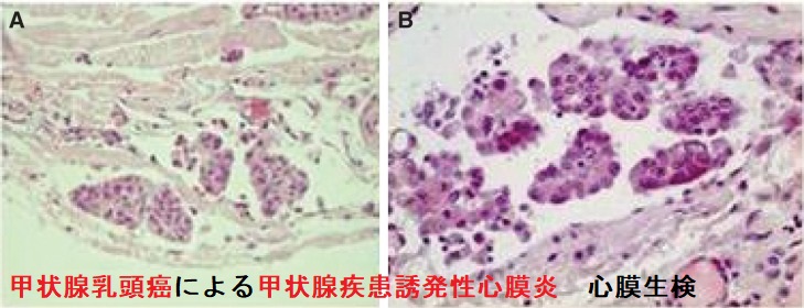 甲状腺乳頭癌による甲状腺疾患誘発性心膜炎 心膜生検 甲状腺乳頭癌による甲状腺疾患誘発性心膜炎 心膜生検