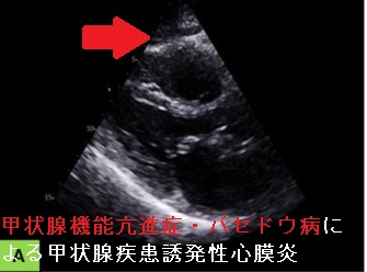 甲状腺機能亢進症・バセドウ病による甲状腺疾患誘発性心膜炎 甲状腺機能亢進症・バセドウ病による甲状腺疾患誘発性心膜炎