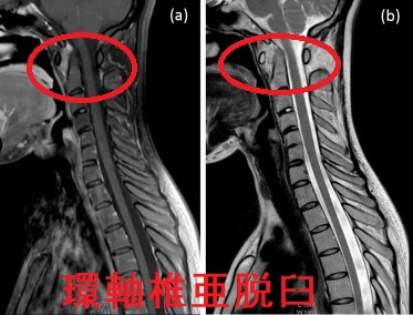 環軸椎亜脱臼 MRI画像 環軸椎亜脱臼 MRI画像
