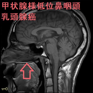 甲状腺様低位鼻咽頭乳頭腺癌 甲状腺様低位鼻咽頭乳頭腺癌2