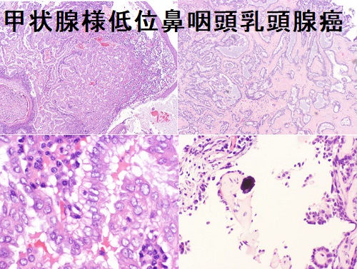 甲状腺様低位鼻咽頭乳頭腺癌 甲状腺様低位鼻咽頭乳頭腺癌