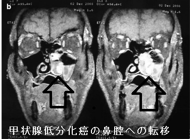 甲状腺低分化癌の鼻腔への転移 MRI画像 甲状腺低分化癌の鼻腔への転移 MRI画像
