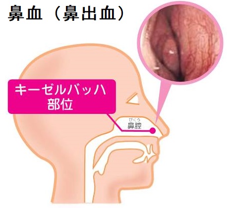 キーゼルバッハ部位 キーゼルバッハ部位