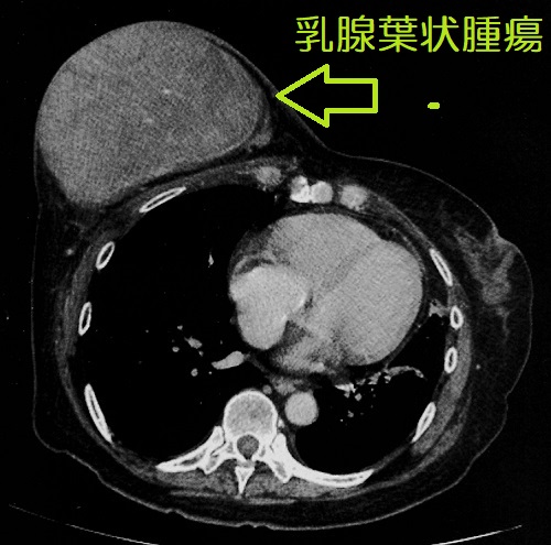 乳腺葉状腫瘍 CT画像 乳腺葉状腫瘍 CT画像