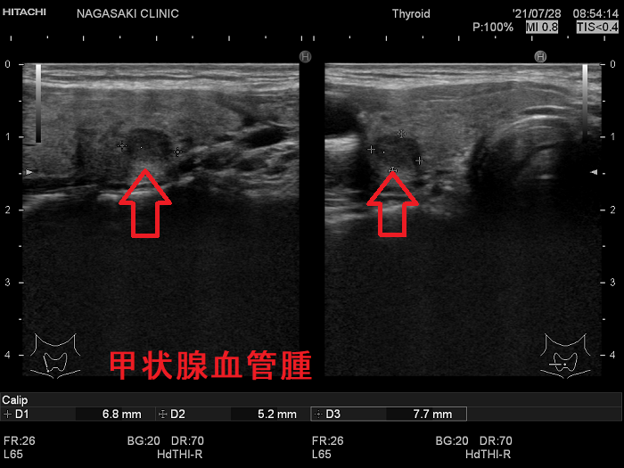 甲状腺血管腫 超音波(エコー)画像 甲状腺血管腫 超音波(エコー)画像