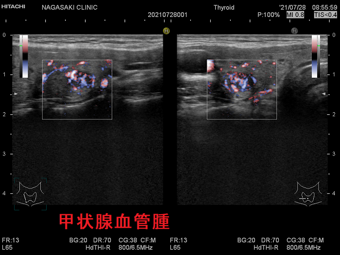 甲状腺血管腫 超音波(エコー)画像 ドプラー 甲状腺血管腫 超音波(エコー)画像 ドプラー