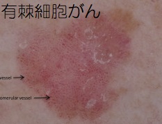 有棘細胞がん(日光角化症) 有棘細胞がん(日光角化症)