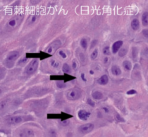 有棘細胞がん(日光角化症) 組織像 有棘細胞がん(日光角化症) 組織像