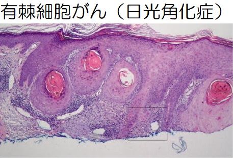 有棘細胞がん(日光角化症) 組織像 有棘細胞がん(日光角化症) 組織像