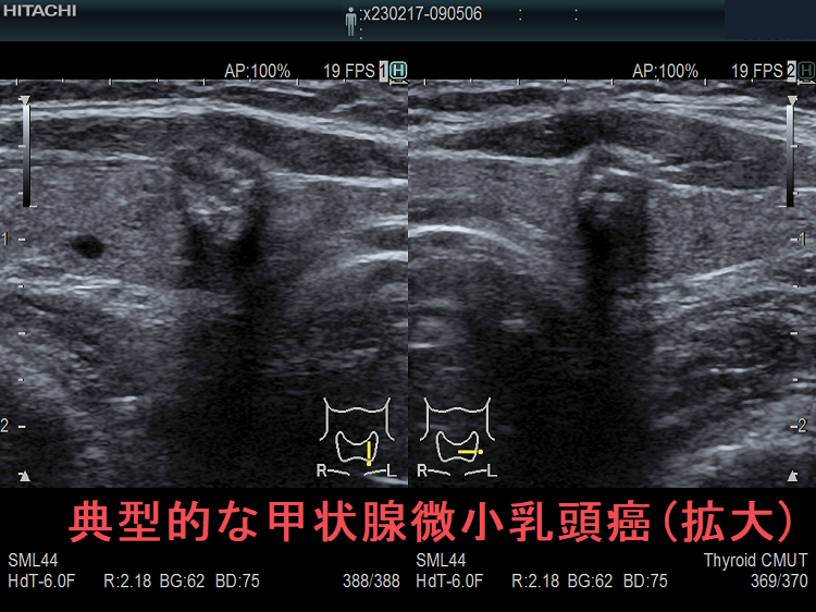 典型的な甲状腺微小乳頭癌 超音波(エコー)画像(拡大) 典型的な甲状腺微小乳頭癌 超音波(エコー)画像(拡大)