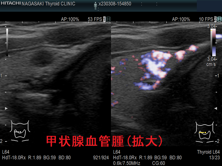 何度穿刺細胞診しても血液成分のみ:甲状腺血管腫(拡大) 何度穿刺細胞診しても血液成分のみ:甲状腺血管腫(拡大)