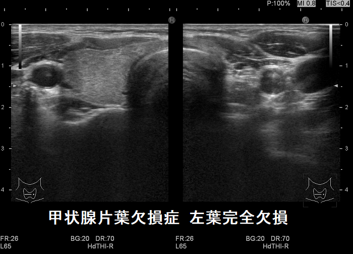 甲状腺片葉欠損症 左葉完全欠損 甲状腺片葉欠損症 左葉完全欠損