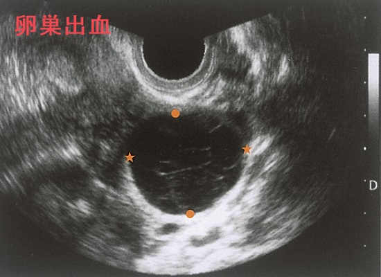 破綻出血・卵巣出血 破綻出血・卵巣出血