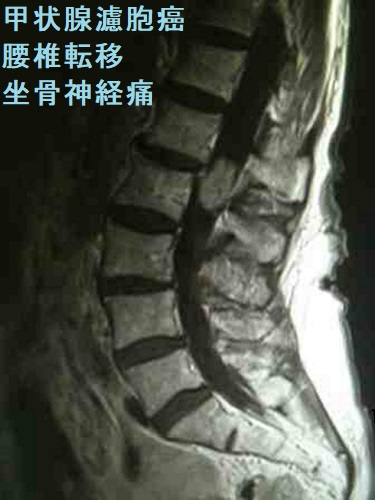 甲状腺濾胞癌 腰椎転移 坐骨神経痛 甲状腺濾胞癌 腰椎転移 坐骨神経痛
