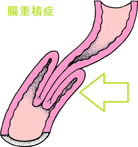 腸重積症 腸重積症